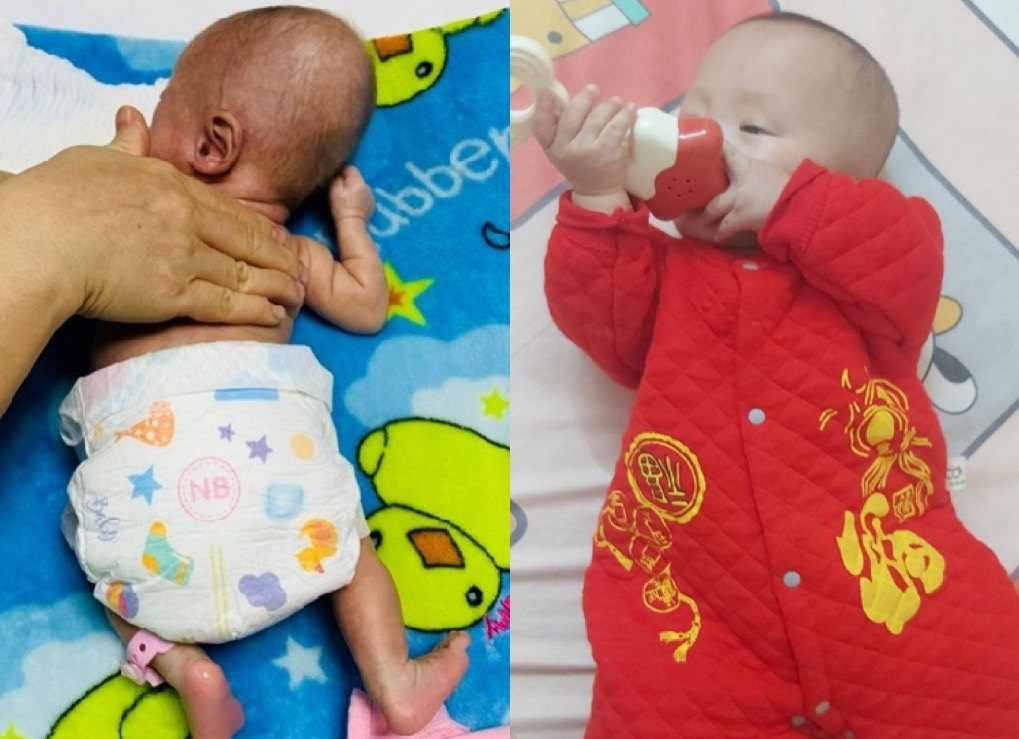 Bé sinh non nặng 400 gr đón cái Tết đầu tiên với sự thay đổi bất ngờ