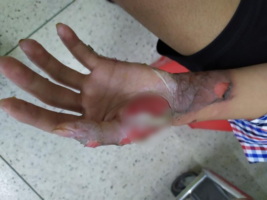TP HCM: Nhiều bệnh nhi dập nát bàn tay vì đốt pháo tự chế