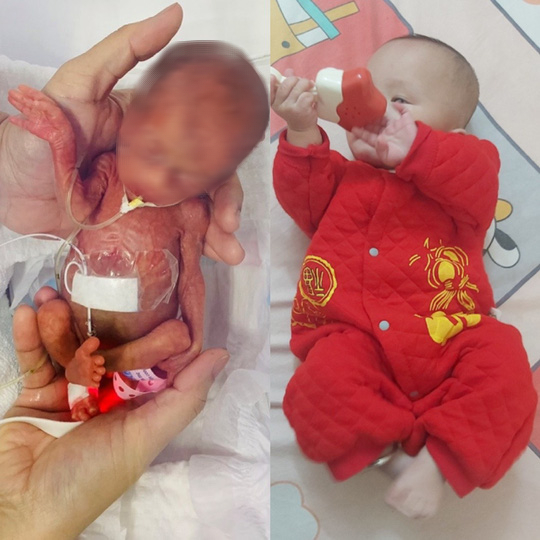 Bé sinh non nặng 400 gr đón cái Tết đầu tiên với sự thay đổi bất ngờ - Ảnh 3.