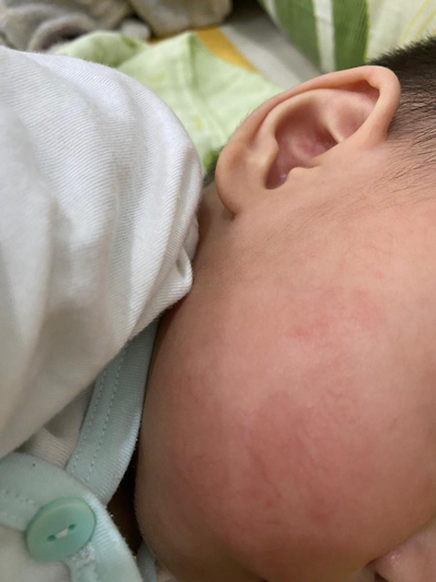 B&eacute; bị ph&aacute;t ban đỏ tr&ecirc;n da, c&oacute; phải l&agrave; Covid-19? - Ảnh 1.