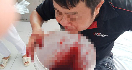 Chảy máu mũi ồ ạt, chàng trai bưng xô hứng, chạy vào bệnh viện cầu cứu