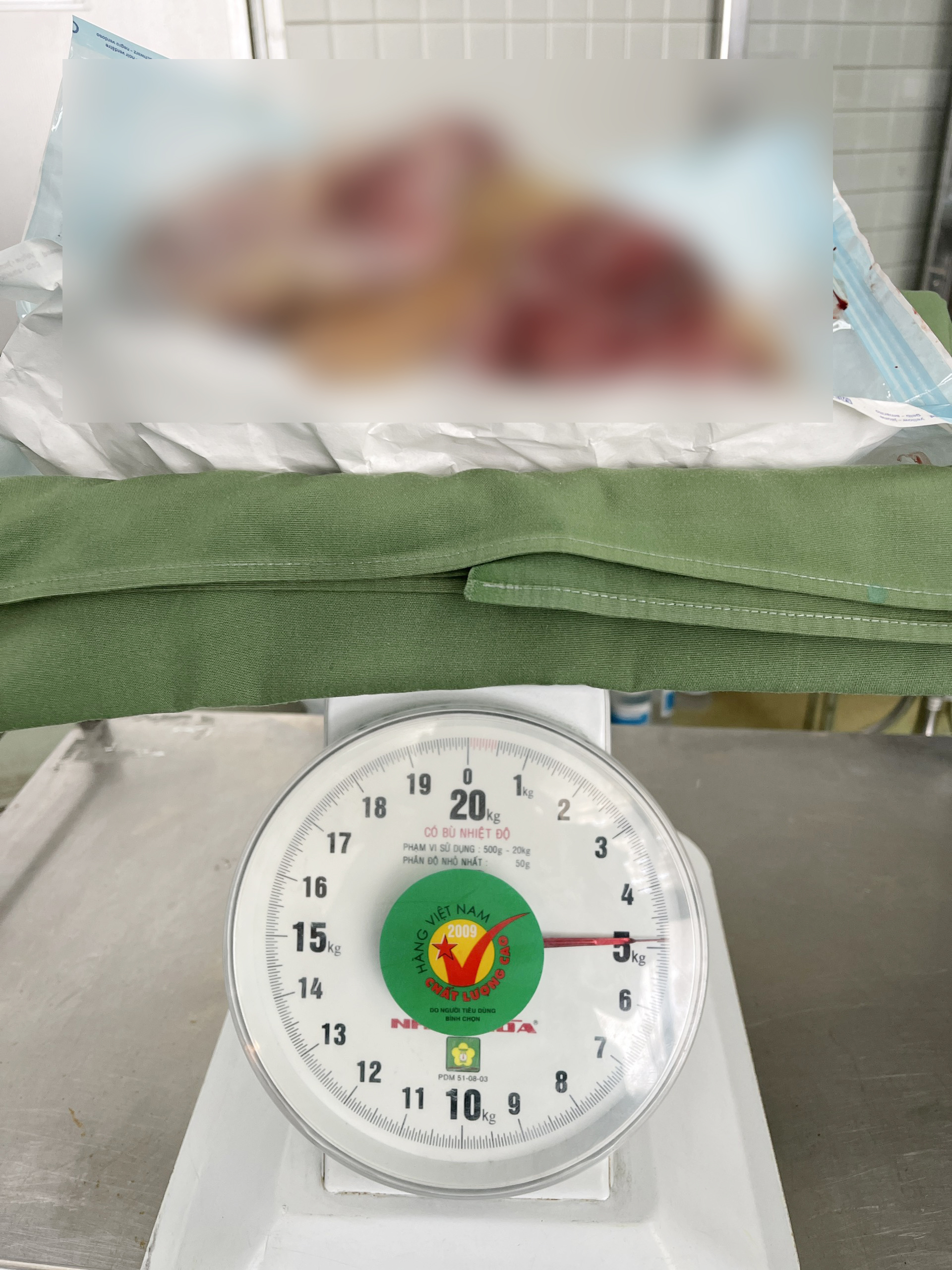 Người phụ nữ gần 4 năm sống với khối u v&uacute; khổng lồ - Ảnh 1.