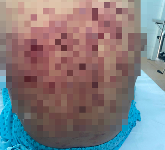 Phát ban, rụng tóc, miệng loét bất thường: Coi chừng mắc bệnh hiếm gặp