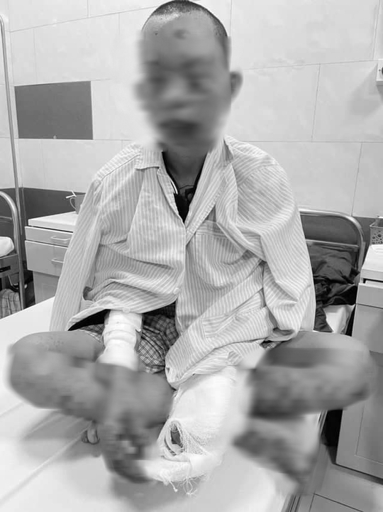 Dùng điện thoại khi đang sạc, nam thanh niên cháy sém toàn thân - Ảnh 1.
