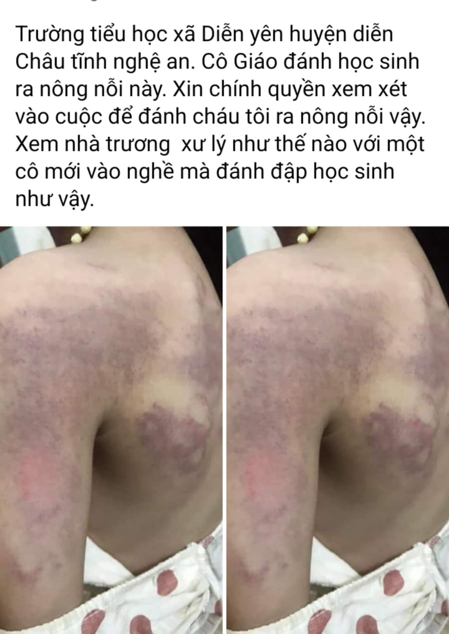 Nghi vấn bé gái lớp 3 bị cô giáo đánh bầm tím người vì không làm được bài