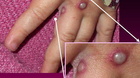 Sau châu Âu, tới lượt Mỹ dính bệnh đậu mùa khỉ hiếm gặp