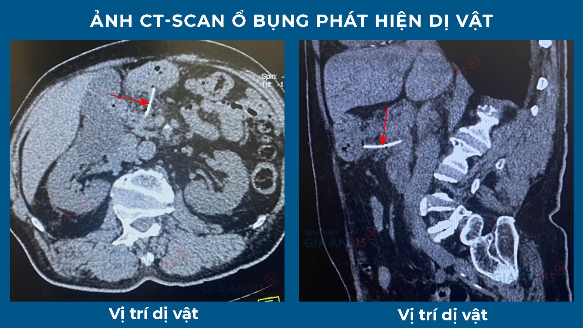 Cụ ông suýt chết vì bị xương cá xuyên thủng dạ dày