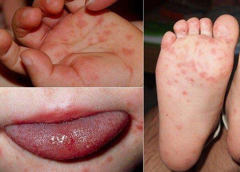 Hơn 5.500 ca tay chân miệng, Bộ Y tế cảnh báo dịch gia tăng
