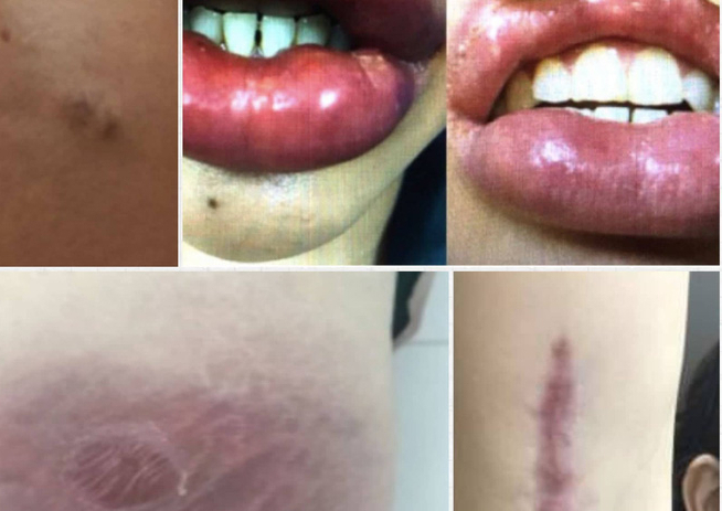 Tiêm filler "đội lốt" collagen, nhiều người gặp biến chứng
