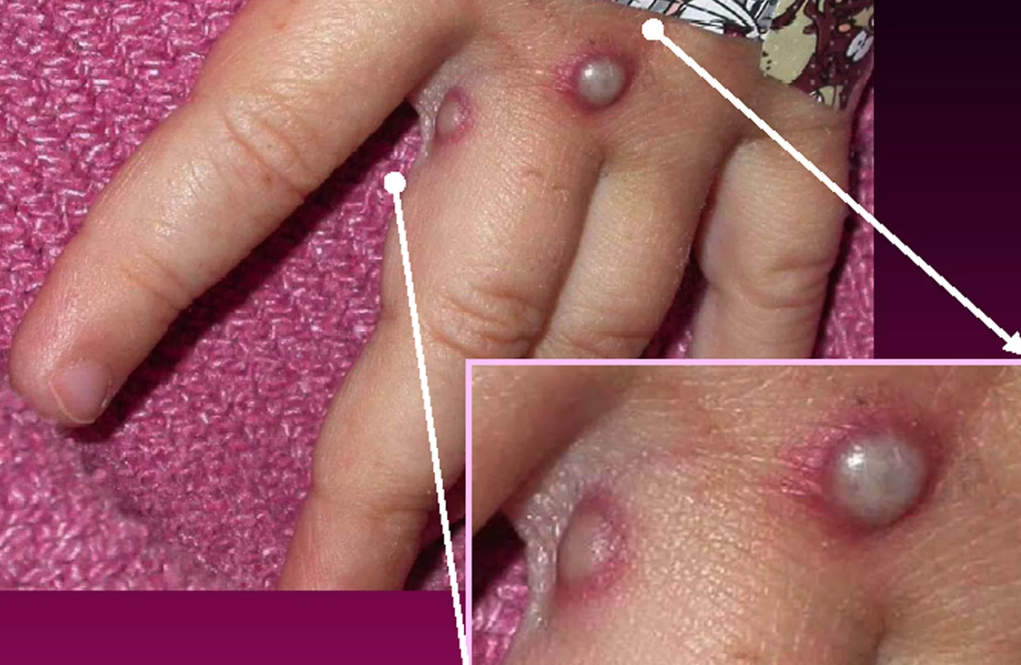 Bộ Y tế n&ecirc;u 6 biện ph&aacute;p ph&ograve;ng chống bệnh đậu m&ugrave;a khỉ - Ảnh 1.
