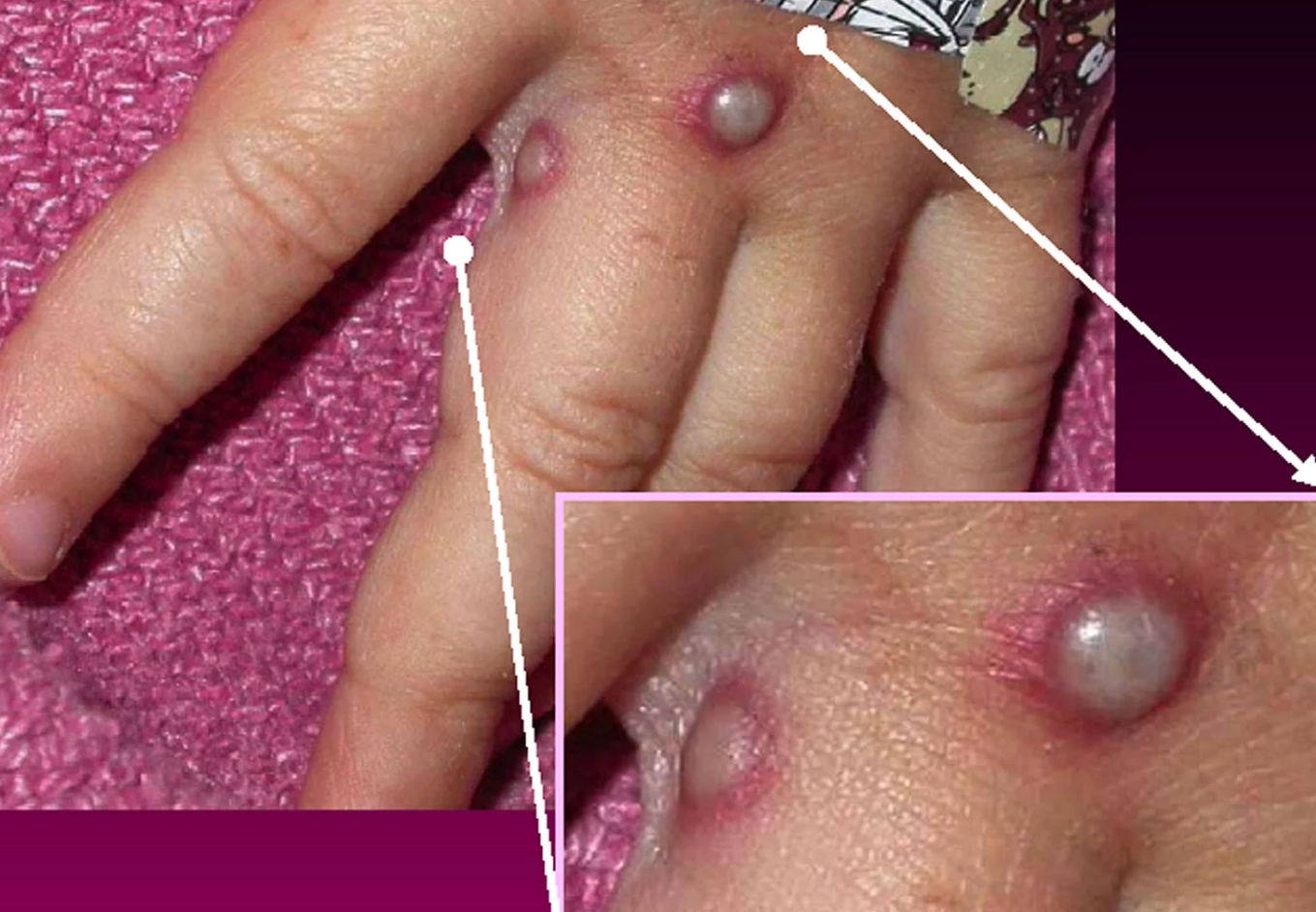 Bộ Y tế nêu 6 biện pháp phòng chống bệnh đậu mùa khỉ
