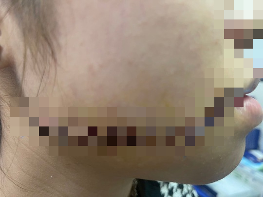 Cứu kịp thời cô gái bị người yêu chém rách toạc nửa mặt