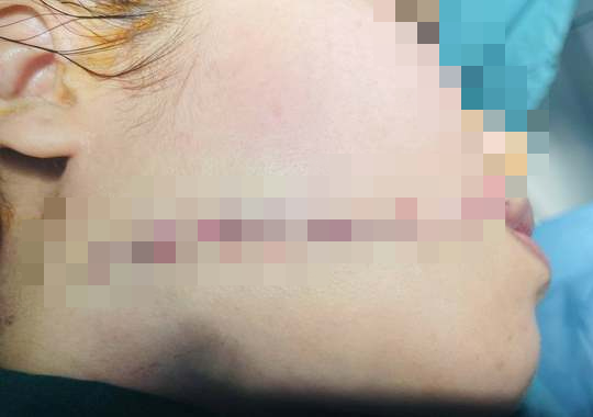 Cứu kịp thời c&ocirc; g&aacute;i bị người y&ecirc;u ch&eacute;m r&aacute;ch toạc nửa mặt - Ảnh 2.