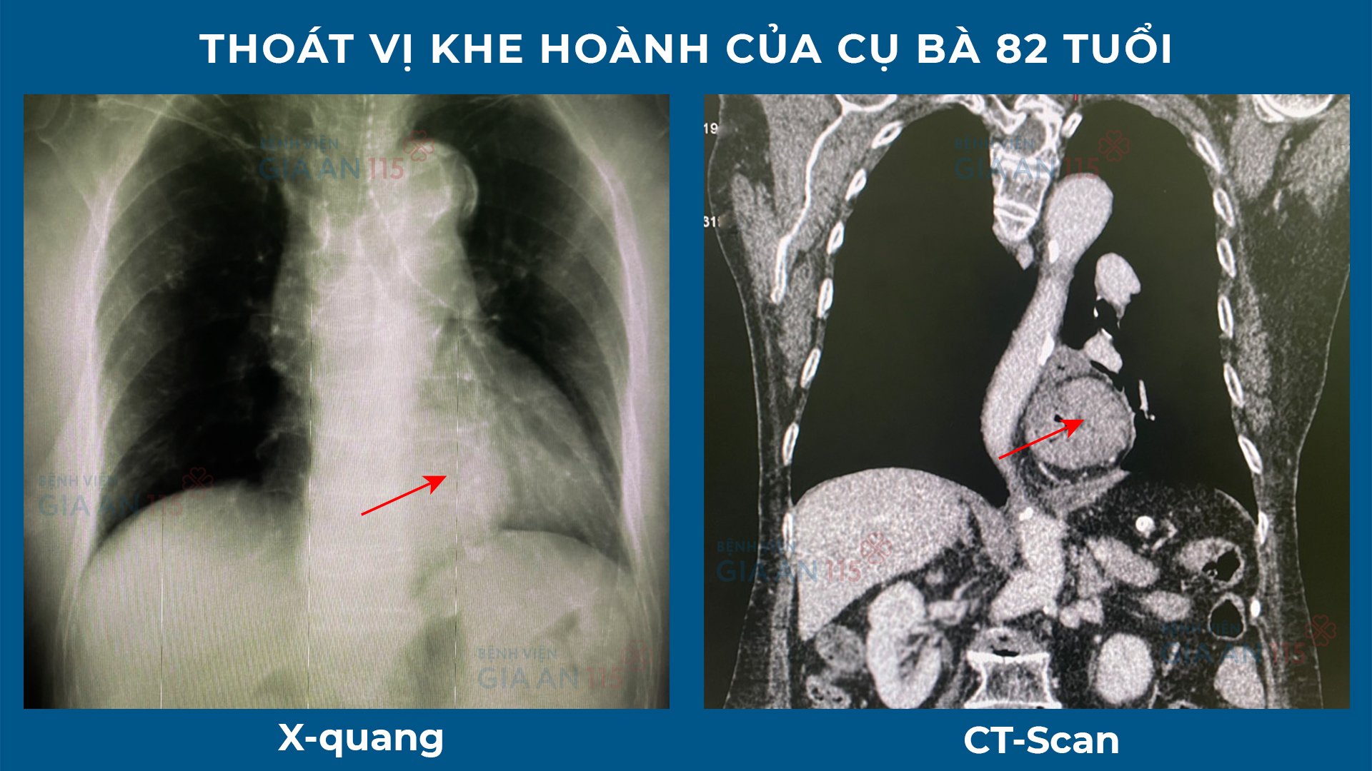 Kịp cứu ca bệnh 10 năm uống thuốc nhầm