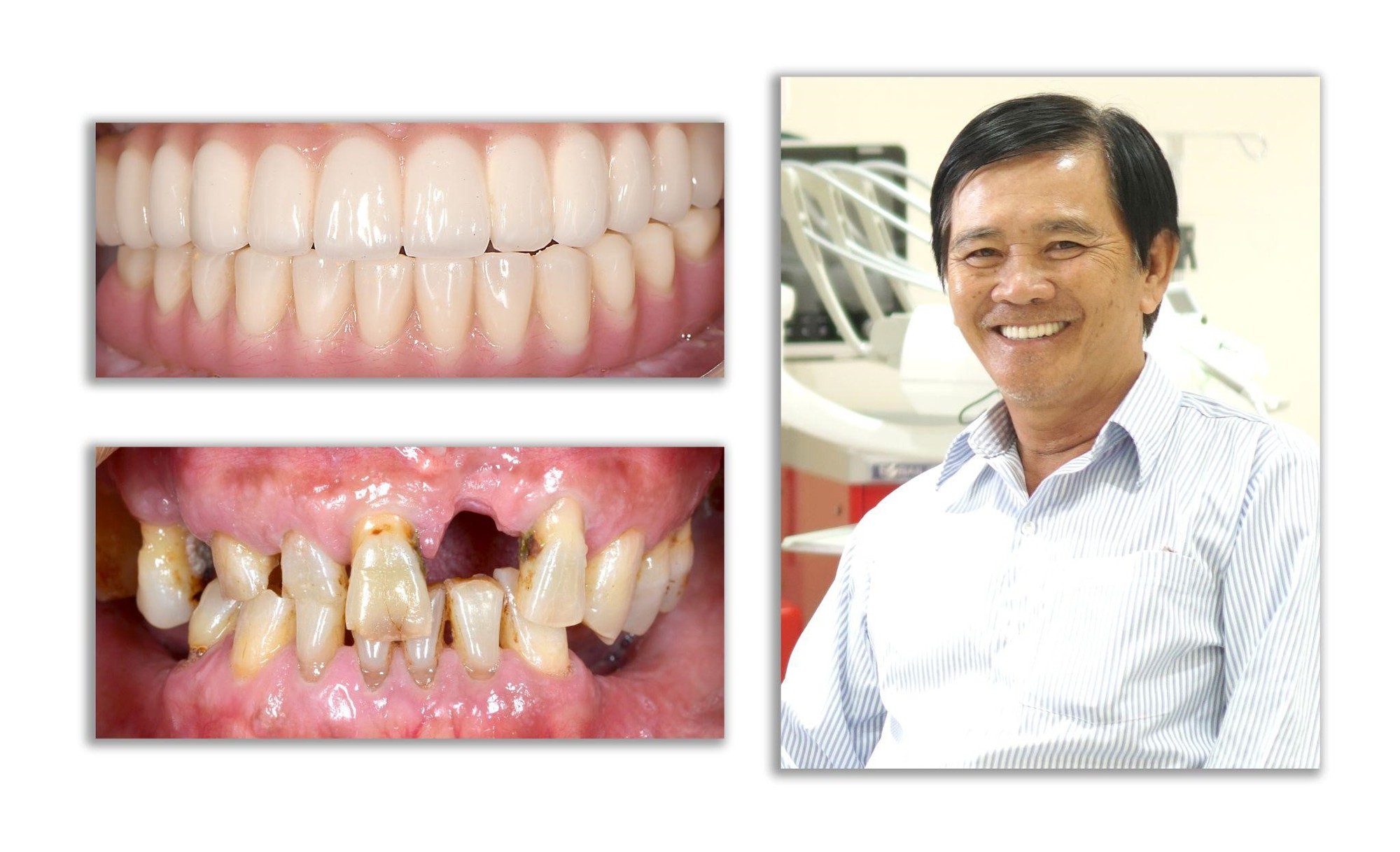 Giải pháp tối ưu trong điều trị mất răng toàn hàm từ nghiên cứu của TS Trần Hùng Lâm