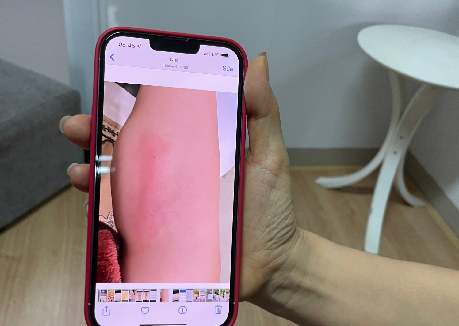 Chi 60 triệu ti&ecirc;m collagen tươi l&agrave;m thẳng ch&acirc;n, người phụ nữ bị biến chứng - Ảnh 1.