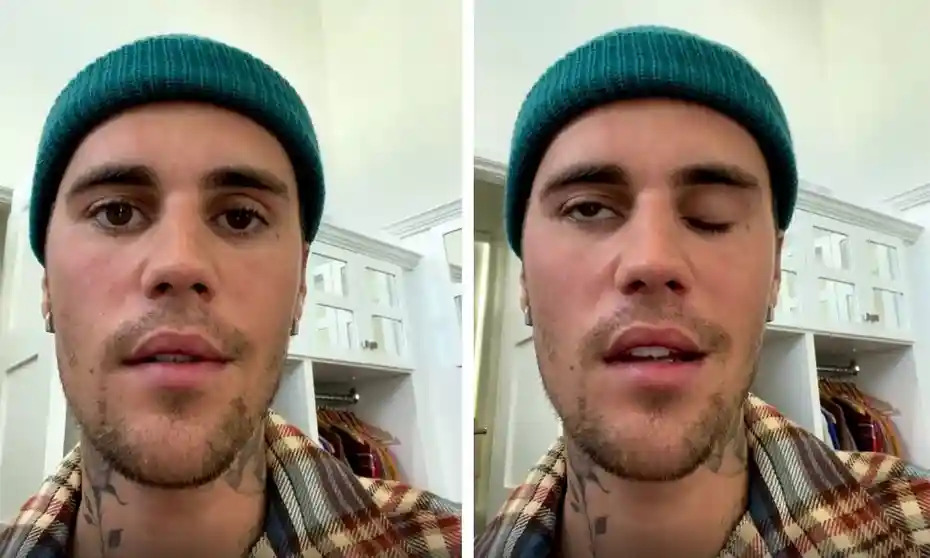 Ca sĩ Justin Bieber bị liệt nửa mặt v&igrave; virus tấn c&ocirc;ng - Ảnh 1.