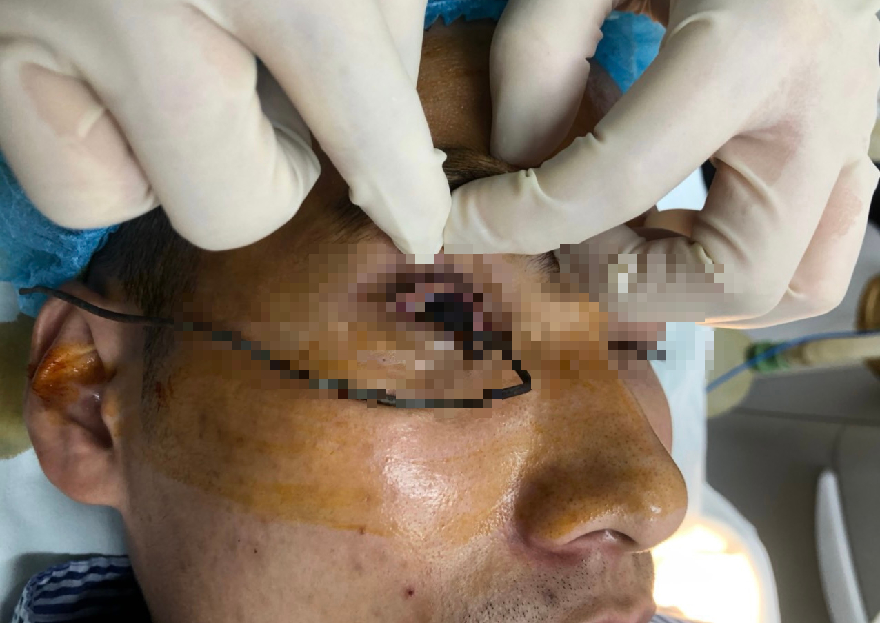 Nam thanh niên bị dây thép dài găm chặt vào mắt