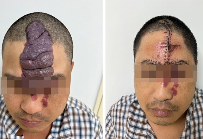 Tái tạo khuôn mặt cho thanh niên bị khối dị dạng mạch máu khổng lồ