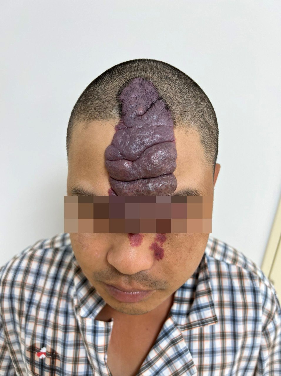 T&aacute;i tạo khu&ocirc;n mặt cho thanh ni&ecirc;n bị khối dị dạng mạch m&aacute;u khổng lồ - Ảnh 1.