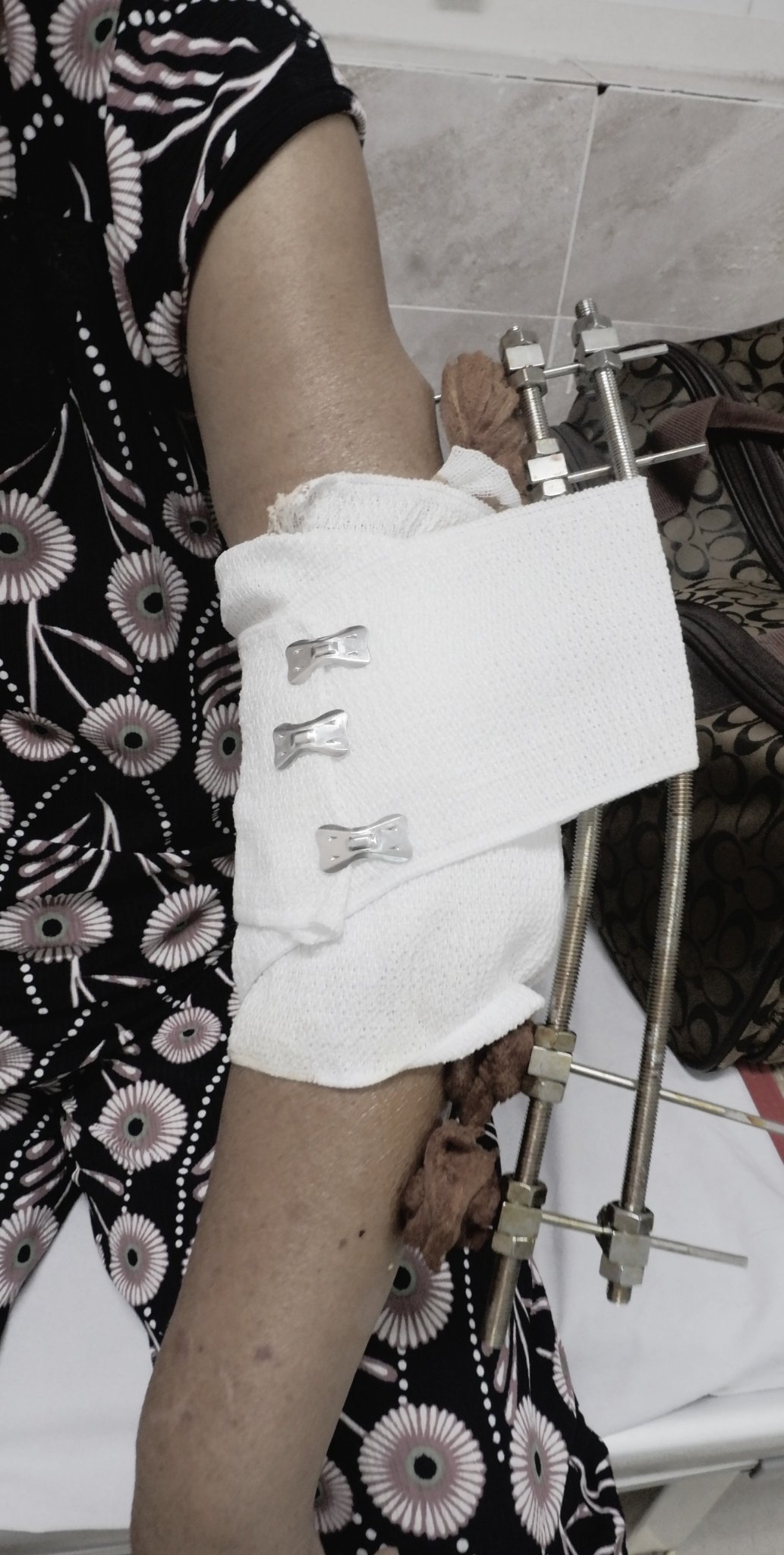 Nhiễm trùng nặng, hủy xương tay vì bó thuốc lá trị viêm khớp