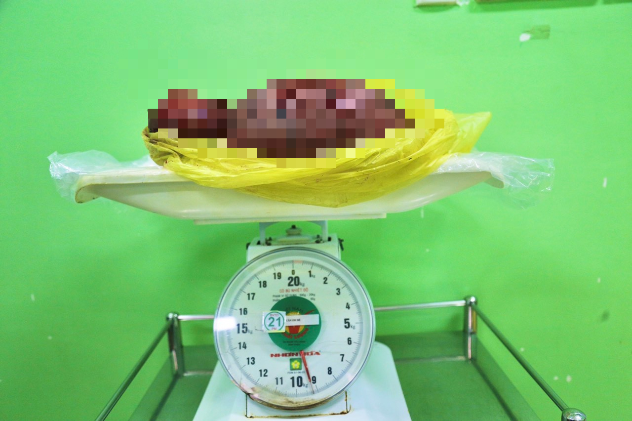 TP HCM: Người phụ nữ mang khối u hơn 9kg tưởng mình mập lên