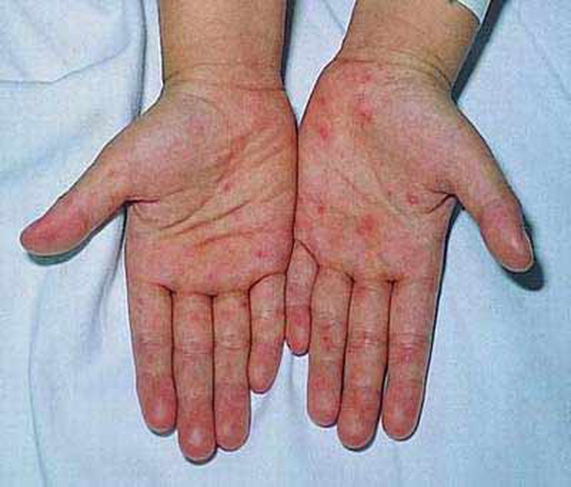 Những dấu hiệu đáng lo ngại cần đưa người mắc sốt xuất huyết đến ngay y tế