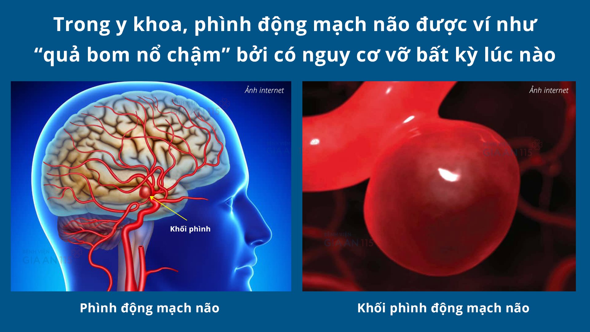 Người đàn ông bị phình động mạch não giữa kích thước "khổng lồ"