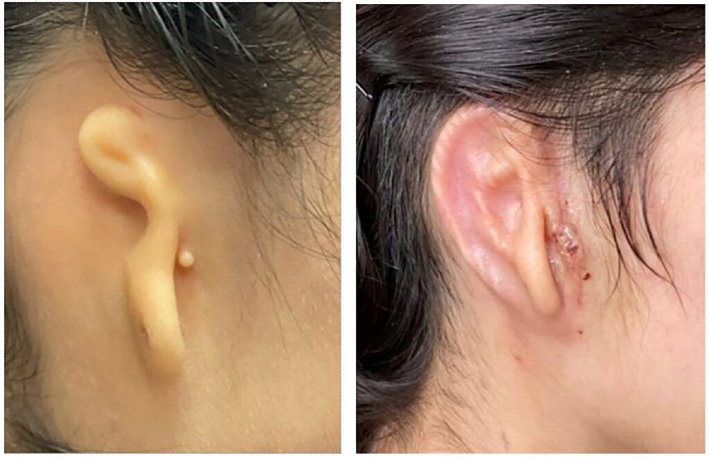 Lần đầu tiên trên thế giới: In 3D tai người, cấy ghép thành công cho cô gái - Ảnh 3.