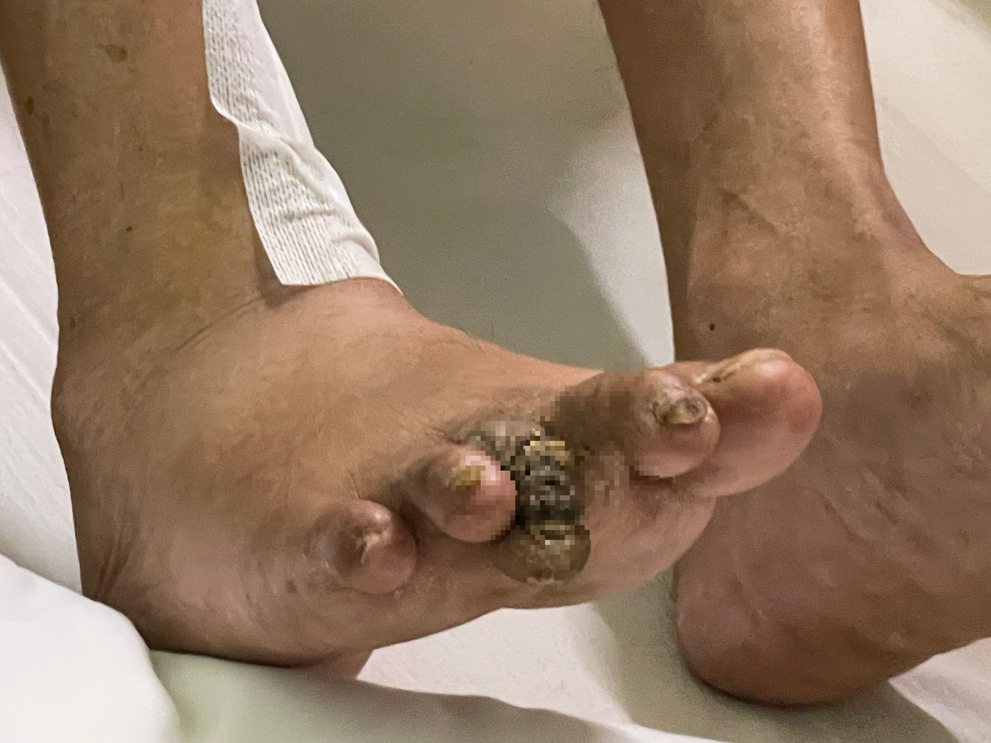 Chân đau như chuột rút có thể là dấu hiệu thiếu máu chi dưới - Ảnh 2.