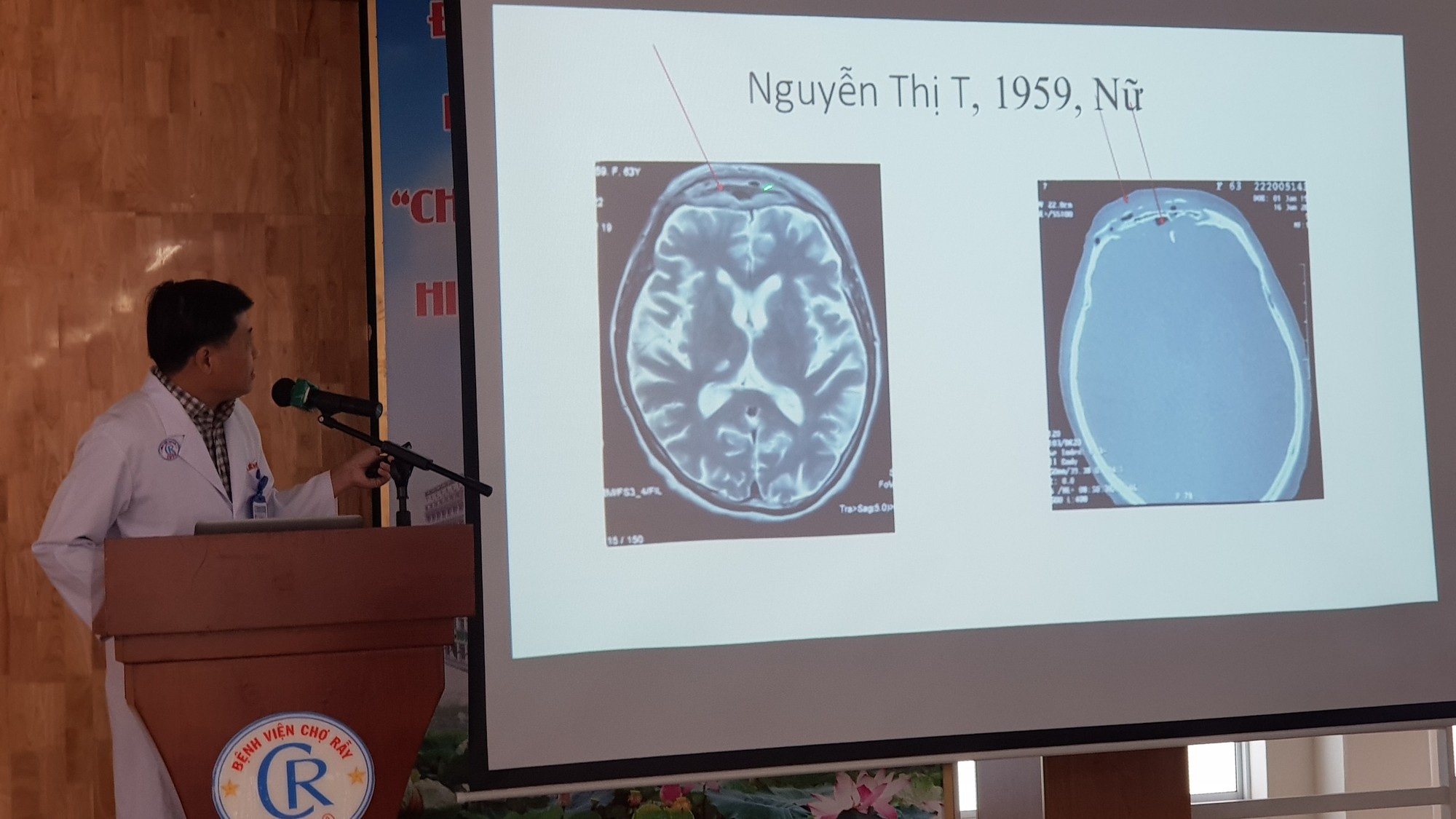 Hàng loạt ca Covid-19 áp xe, hoại tử sọ mặt