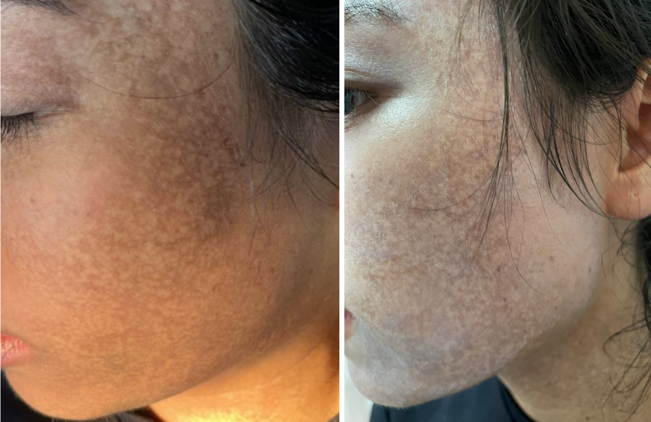 Mặt c&ocirc; g&aacute;i trẻ đen sạm sau khi chi 70 triệu đồng để lăn kim, lột da trị n&aacute;m tại spa - Ảnh 2.