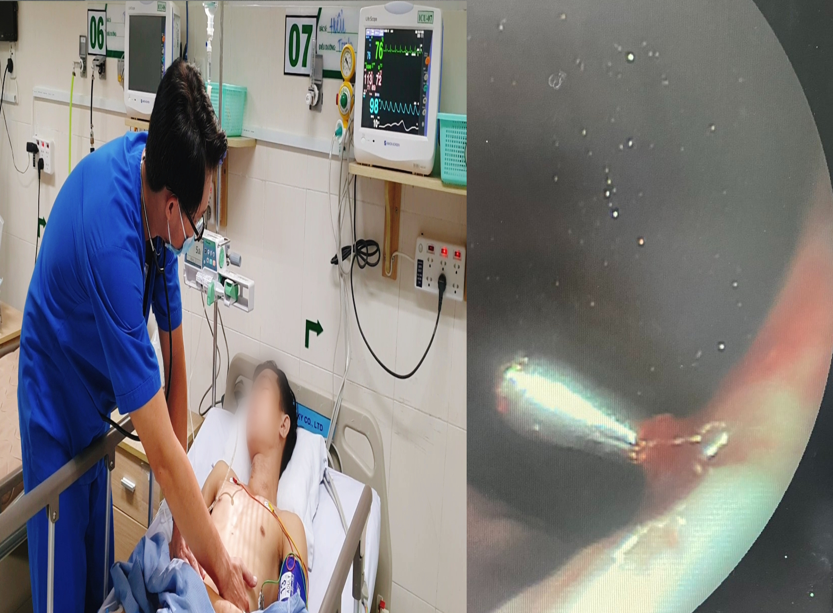 Diễn viên xiếc ở Cần Thơ nôn ra 1/2 lít máu sau khi biểu diễn