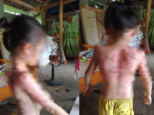 Người phụ nữ ghen tu&ocirc;ng, hắt nước s&ocirc;i khiến b&agrave; mẹ v&agrave; 2 con nhỏ bỏng nặng - Ảnh 1.