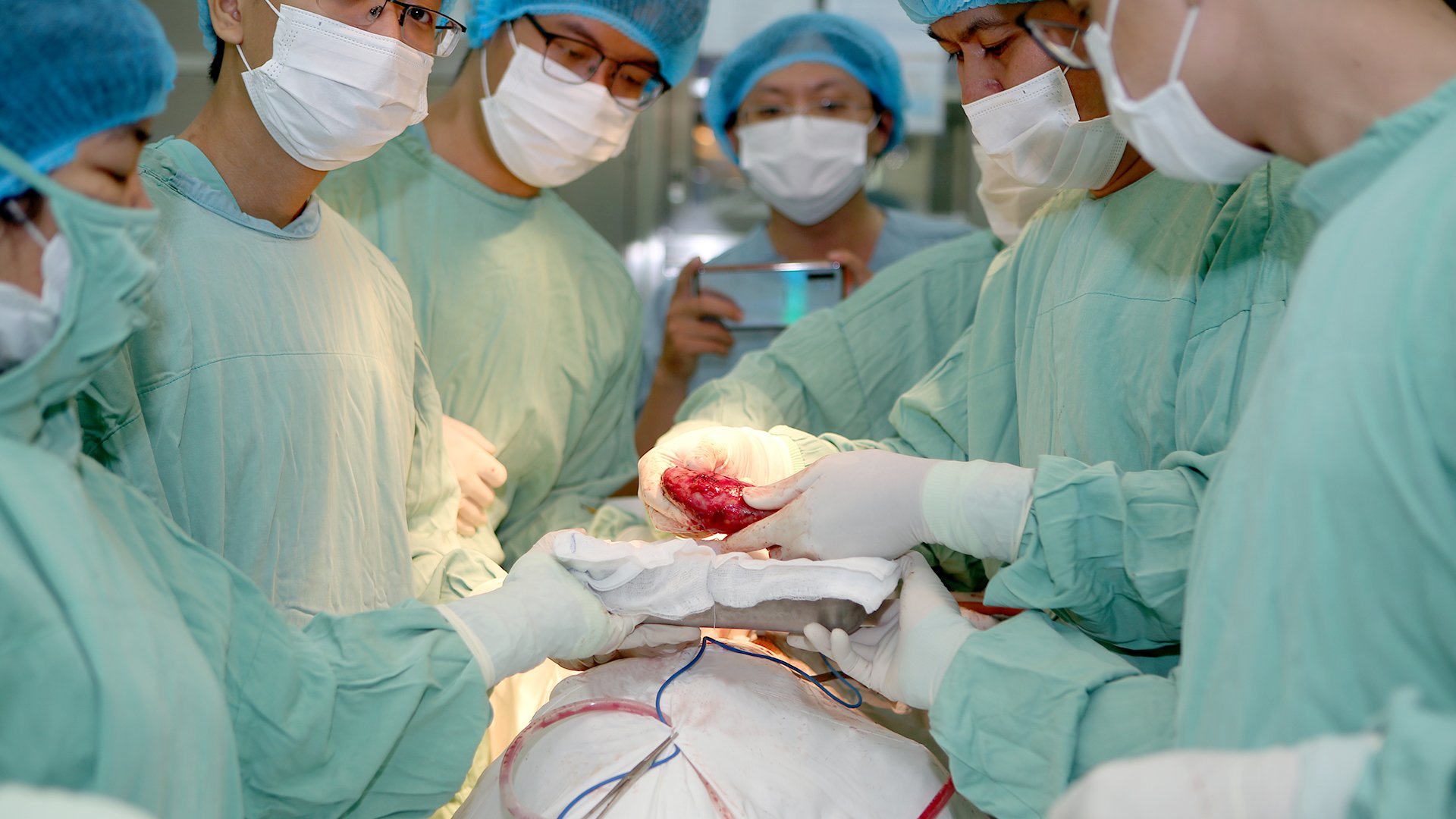 Cứu sống bệnh nhân bị biến chứng trong quá trình tán sỏi - Ảnh 1.