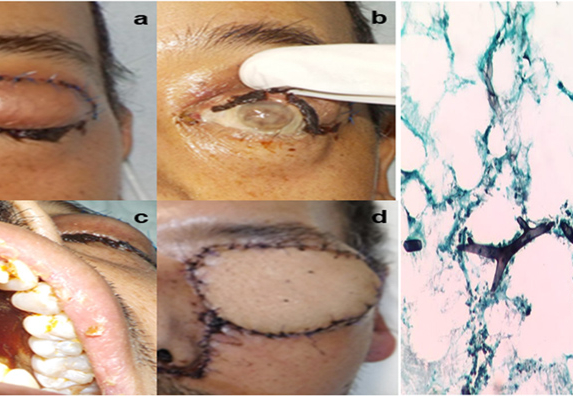 Hà Nội ghi nhận 3 ca hoại tử xương hàm