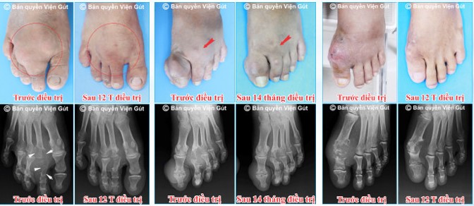 Người bị bệnh gút không còn lo đau nhức do biến chứng