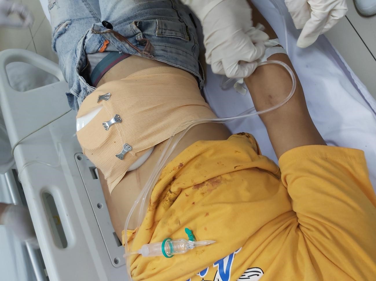 Thanh niên bị đâm thủng bụng nguy kịch