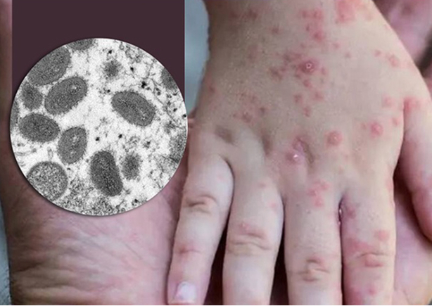 Tốc độ lây nhiễm của đậu mùa khỉ và SARS-CoV-2 khác nhau thế nào?