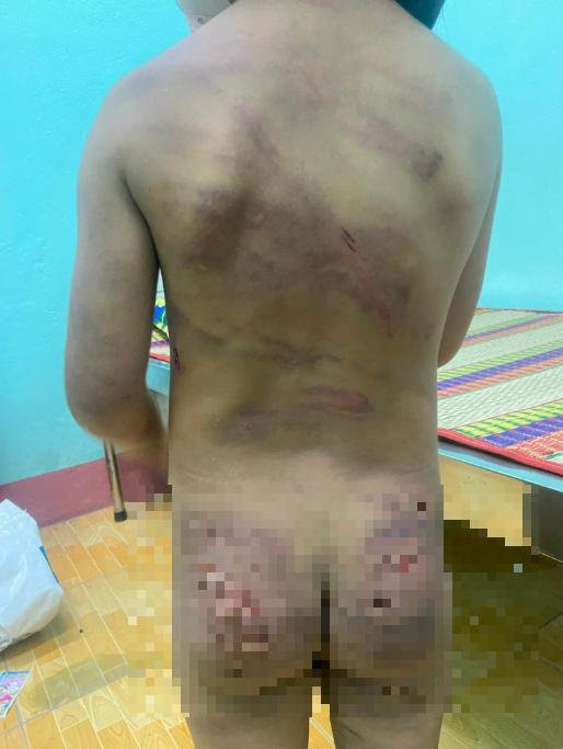 Bé gái mang đầy vết thương gây dậy sóng mạng xã hội ở cùng mẹ và cha dượng