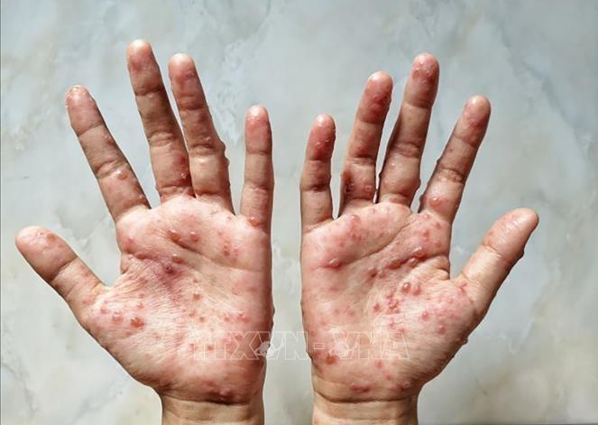 Bộ Y tế: Người mắc bệnh đậu mùa khỉ cách ly tối thiểu 14 ngày