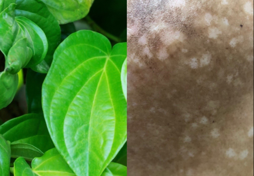 Đắp "thần dược" trị nám, mặt người phụ nữ trẻ xám xịt, loang lổ
