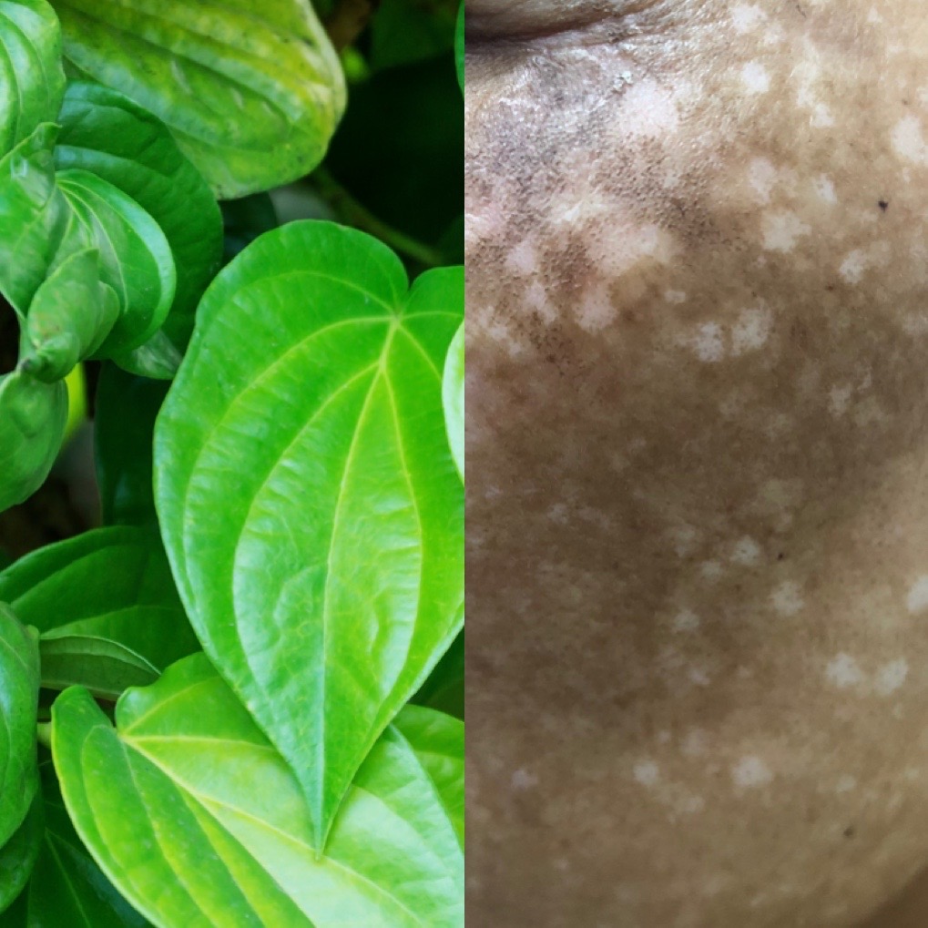 Đắp thần dược trị n&aacute;m, mặt người phụ nữ trẻ x&aacute;m xịt, loang lổ - Ảnh 1.