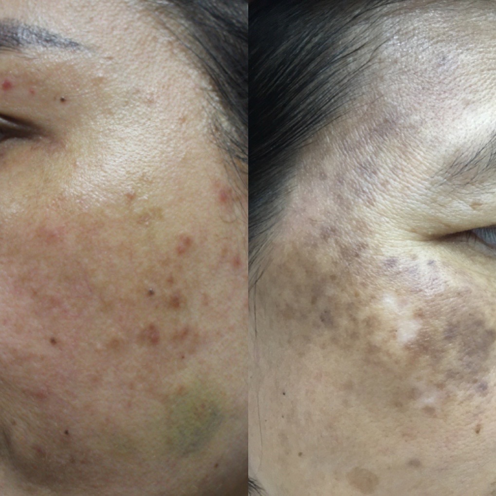 Đắp thần dược trị n&aacute;m, mặt người phụ nữ trẻ x&aacute;m xịt, loang lổ - Ảnh 2.