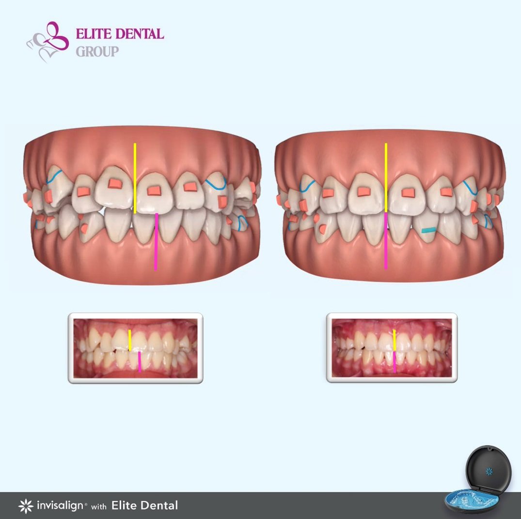 M&aacute;ch nhỏ chị em c&aacute;ch &ldquo;niềng răng v&ocirc; h&igrave;nh&rdquo;, đảm bảo t&iacute;nh thẩm mỹ cao - Ảnh 1.