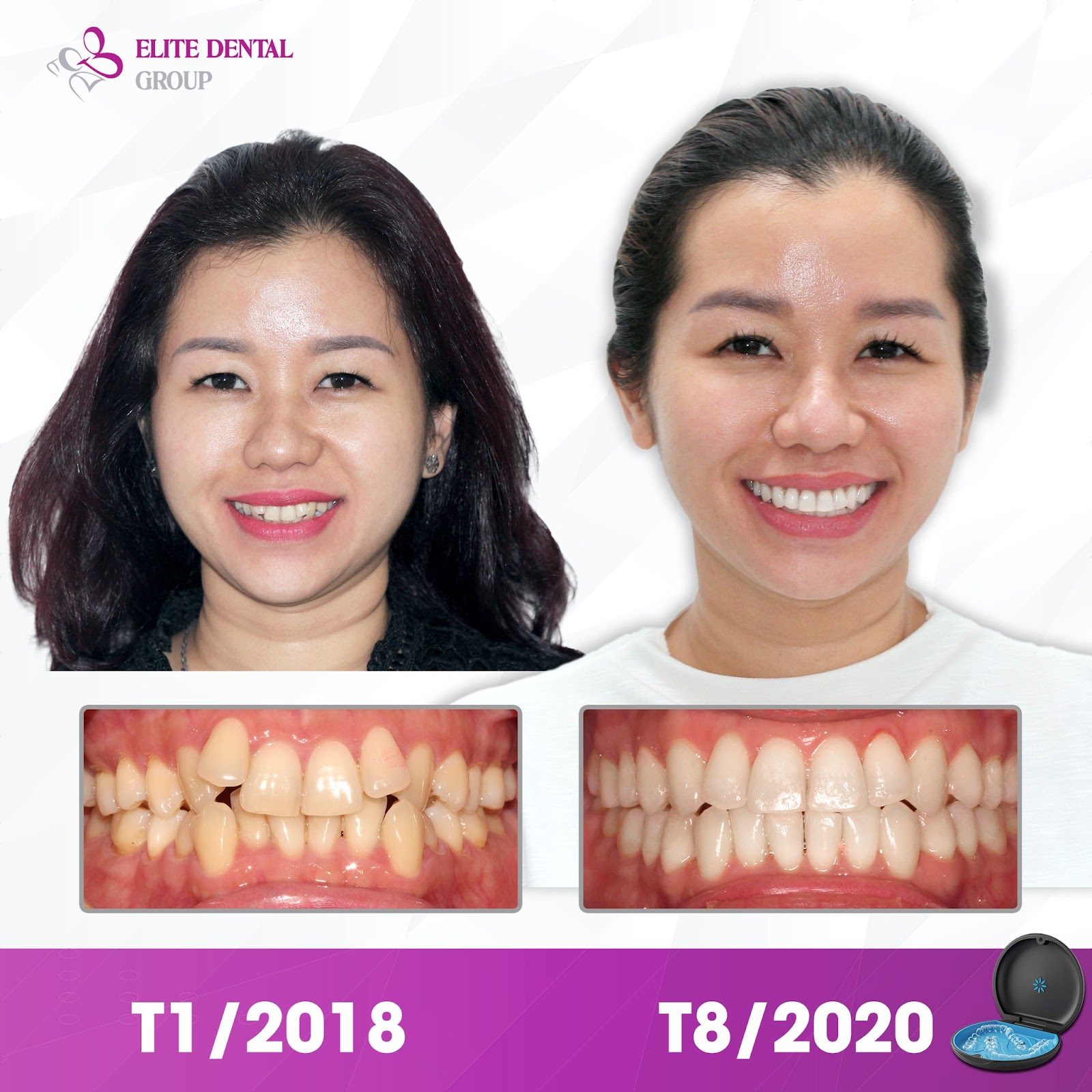 M&aacute;ch nhỏ chị em c&aacute;ch &ldquo;niềng răng v&ocirc; h&igrave;nh&rdquo;, đảm bảo t&iacute;nh thẩm mỹ cao - Ảnh 2.