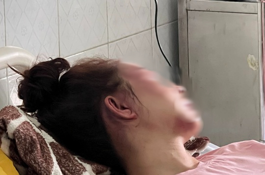 Cán bộ QLTT đánh bạn gái dập mũi, vỡ hàm, chảy máu mắt vì hát song ca với người khác