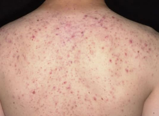 Lăn kim trị mụn lưng, người phụ nữ trẻ suýt mất mạng