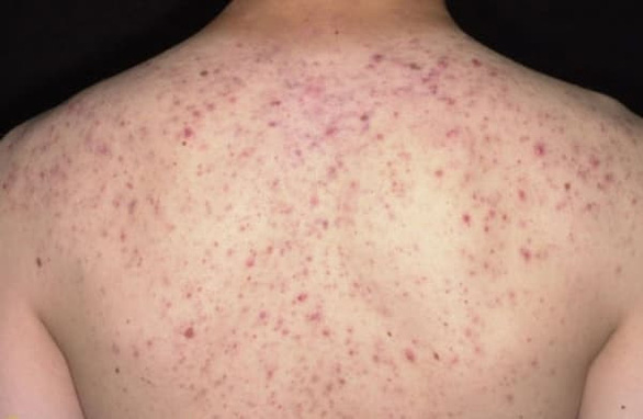 Lăn kim trị mụn lưng, người phụ nữ trẻ suýt mất mạng - Ảnh 1.