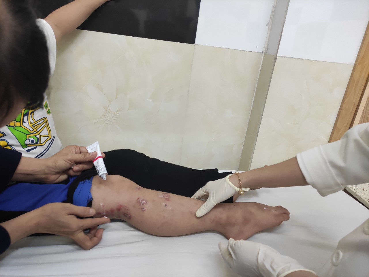 Tự điều trị chốc, nhiều trẻ bị lở loét khắp người